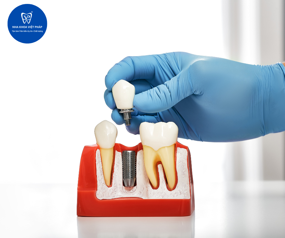 Trồng răng Implant