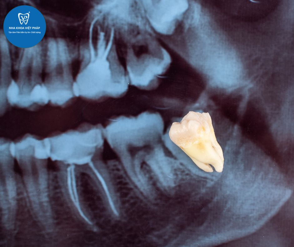 Nhổ răng khôn có đau không?