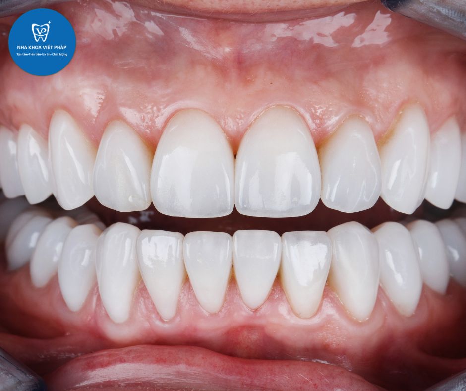 Bọc răng sứ tại Việt Pháp Quốc Oai