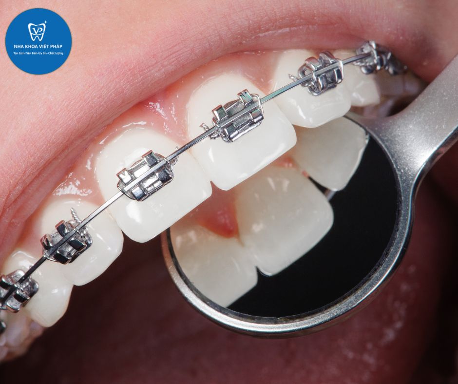 Niềng răng thẩm mỹ Tại Việt Pháp Quốc Oai