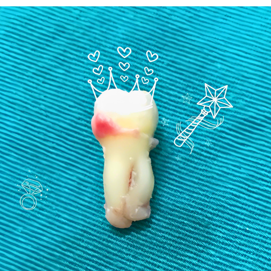 Sự thật về răng khôn