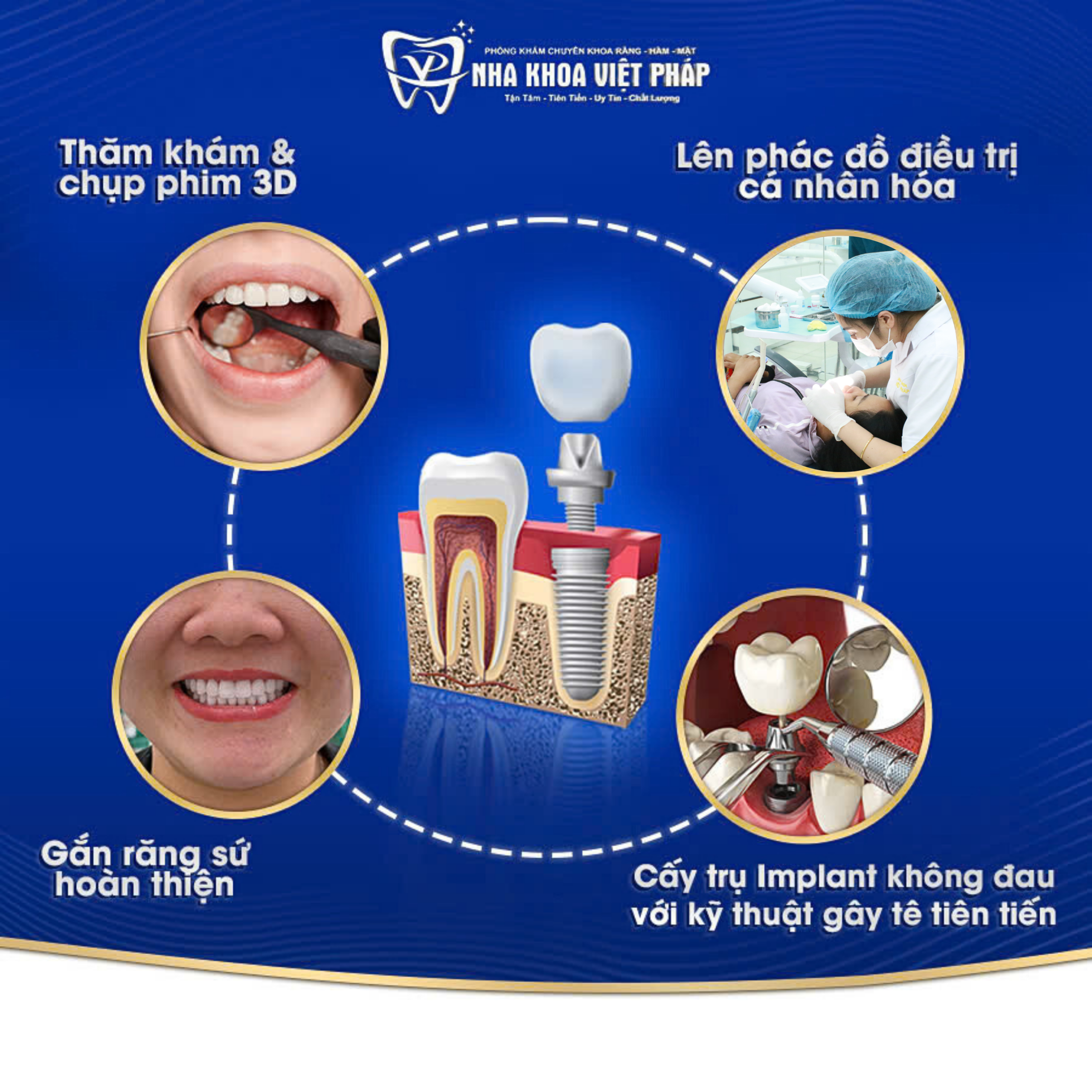 Quy trình trồng răng Implant tại Nha Khoa Việt Pháp